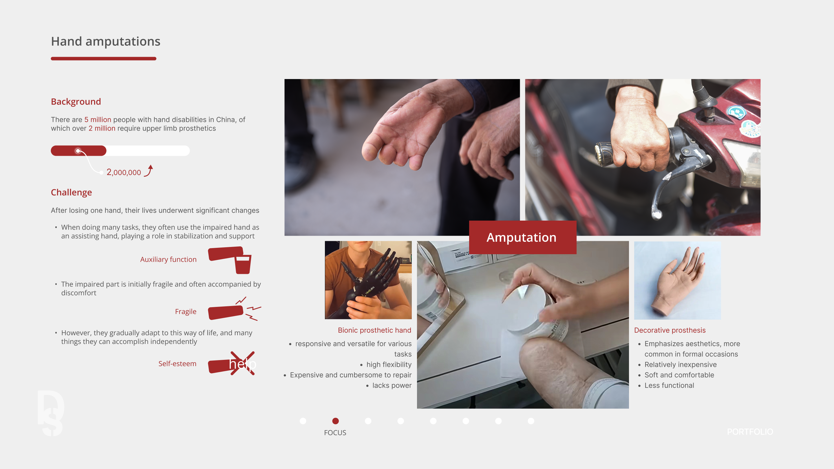 Research board on hand amputations in China, with the 5-million and over-2-million figures and a comparison of bionic versus decorative prostheses.
